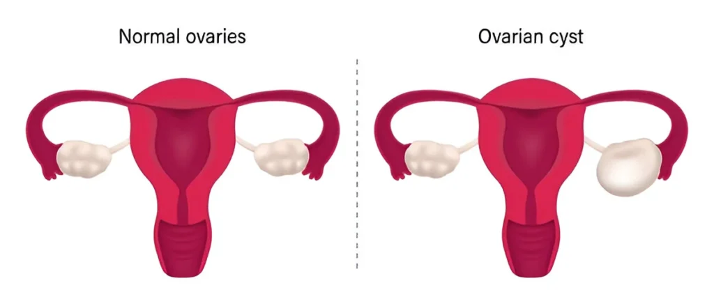 warning signs of ovarian cysts