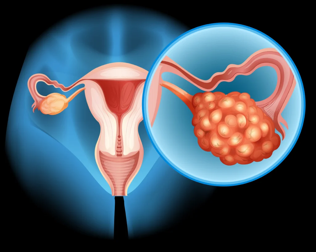best lady gynecologist in Kolkata, Polycystic Ovarian Syndrome