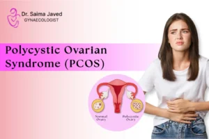 Polycystic Ovarian Syndrome (PCOS): How to Deal With It?